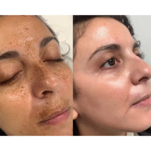 Body Pigmentation Removal