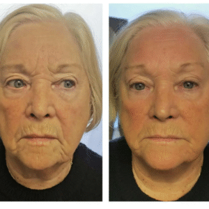 T-Shape 2 | Face - Single Session